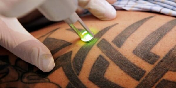 Rimozione Tatuaggi Somma Lombardo